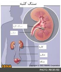 روش‌های مورد‌استفاده در سنگ شکن‌کلیه